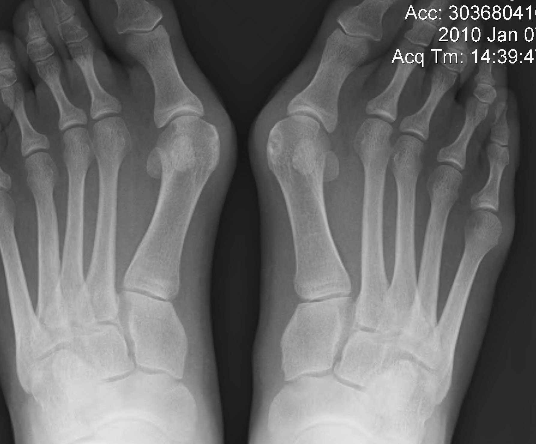 Juvenile Hallux Valgus